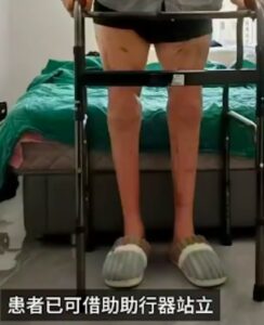 51歲工人雙腿遭機器切斷 手術接回20個月後重新行走 51歲工人雙腿遭機器切斷 手術接回20個月後重新行走